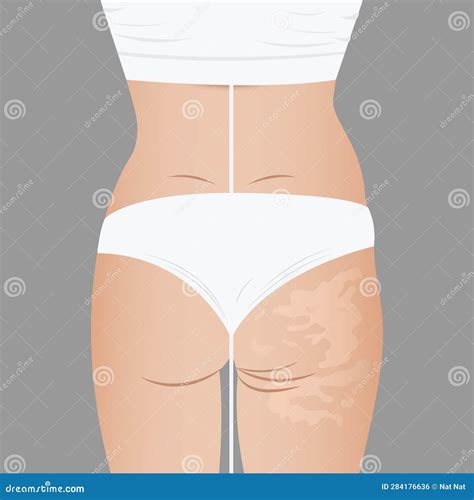 Deep Cellulite Reduction Body Contouring Lifting With Physiotherapy