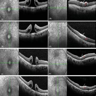 Comparison Of OCT Before And After Treatment For A Recurrent Macular