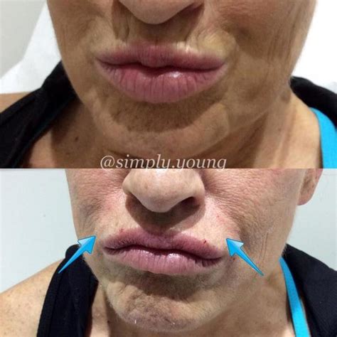 Botox On Smokers Lines Before And After Photos 6 Facial Injections