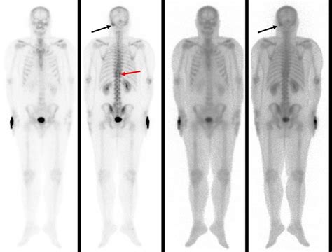 Metastatic hepatocellular carcinoma – Radiology Cases