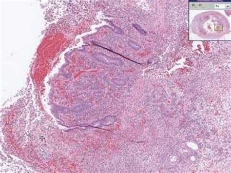 Acute Appendicitis Histology Diagram