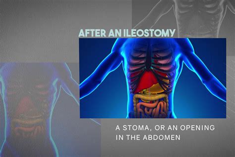 What To Expect After An Ileostomy For Uc