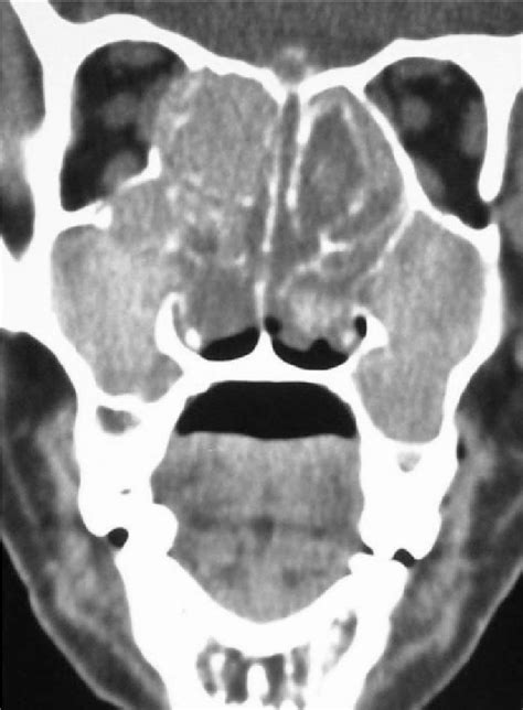 Double Density Sign In Fungal Sinusitis The Primary Safety Objective