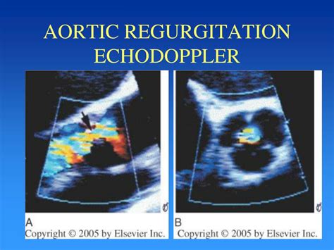 Ppt Aortic Regurgitation Powerpoint Presentation Free Download Id3875684