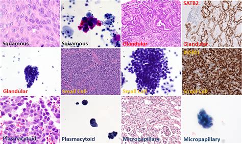 urinary tract cytology showing variant morphology  divergent