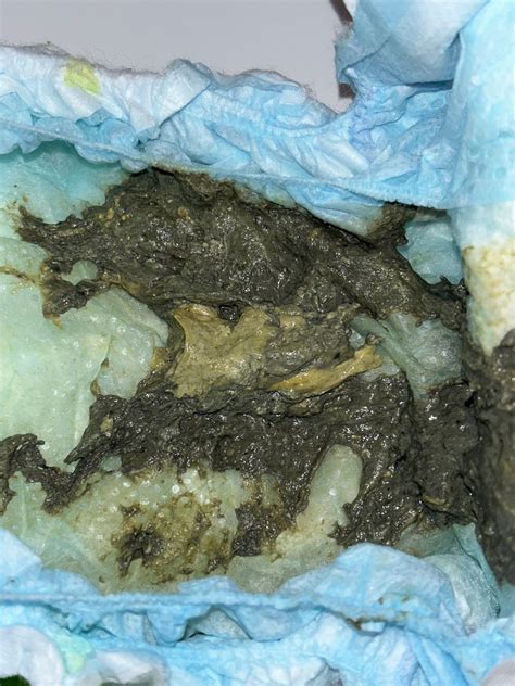 Dark green poop *WARNING PICTURES INCLUDED* | BabyCenter