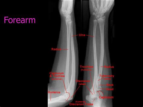 Forearm X Ray Anatomy