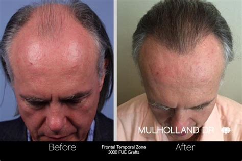 NeoGraft Hair Transplantation Toronto Plastic Surgeons