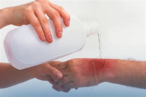 Chemical Burns First Aid Treatment And Prevention Tips