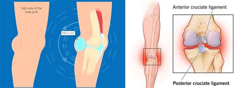 Detr S Del Dolor De Rodilla S Ntomas Causas Tratamiento Con Rodillera