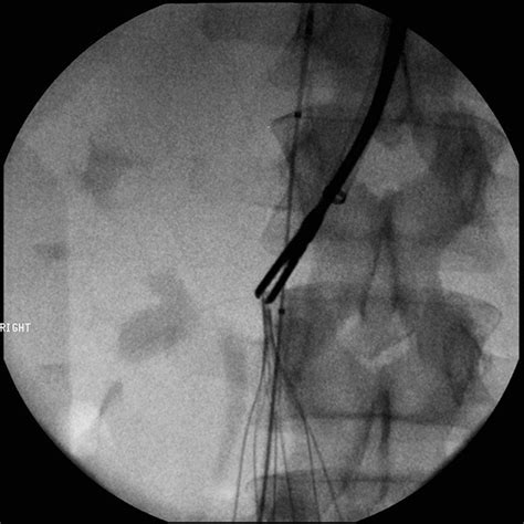 IVC Filter Placement/Removal | Northwest Radiology | Indianapolis ...