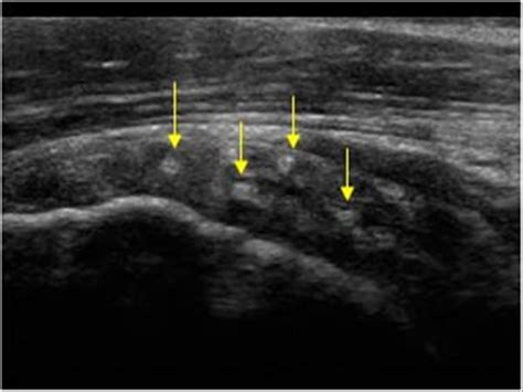 Musculoskeletal Joints And Tendons 6 1 Shoulder Case 6 1 16 Rotator Cuff Surgical Treatment