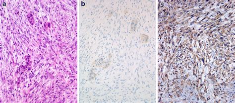 Spindle Cell Carcinoma A Characteristic Biphasic Pattern Small