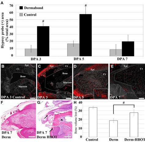 A Oxygen Profiling Of The Epidermis In Control And Dermabond Treated