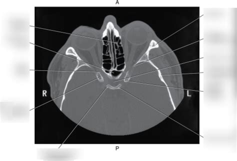 Axial Ct Head 2 Diagram Quizlet