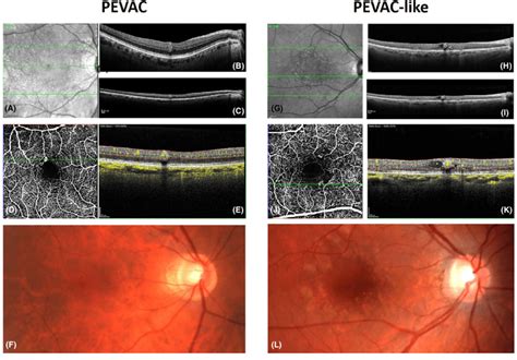 Optical Coherence Tomography Oct Oct A And Cfp Images Of An Eye With