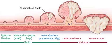 They found colon polyps: Now what? - Harvard Health