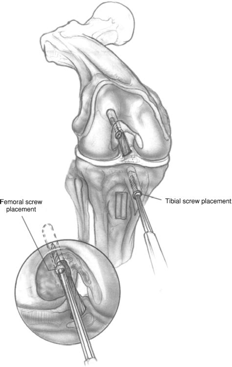 Clubfoot Surgery | Musculoskeletal Key