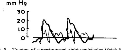 Figure 5 from THE MECHANISM OF THE PULSUS BISFERIENS | Semantic Scholar