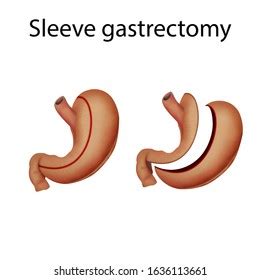 Sleeve Gastrectomy Stomach Surgery Before After Stock Illustration ...