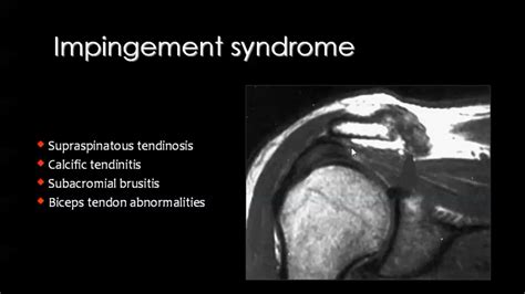 MRI Shoulder Impingement Syndrome