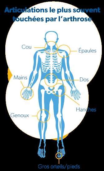 Qu est ce que l arthrose Symptômes causes et traitements Guide complet