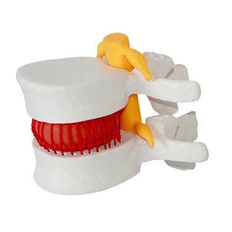 modelo de protrusi  de disco intervertebral lumbar modelo de