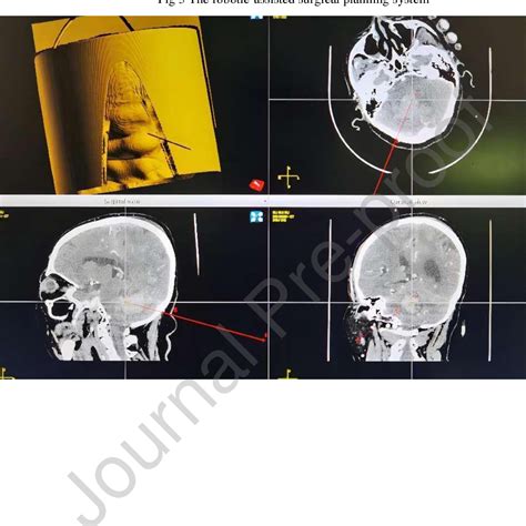 Figure 3 From Surgical Evacuation Of Spontaneous Cerebellar Hemorrhage