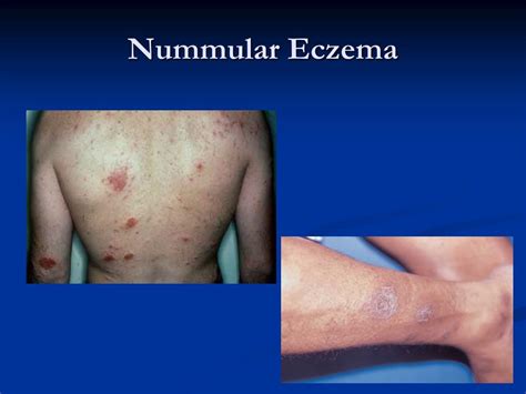 Ppt Atopic Dermatitis Powerpoint Presentation Free Download Id634155