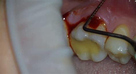 Endodontic Re Treatment Of Mandibular Molar With Endo Perio Lesion And Broken Instrument сases