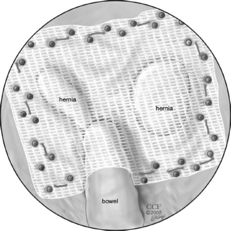 Laparoscopic View Of The Mesh Repair Notice The Tacks Open I