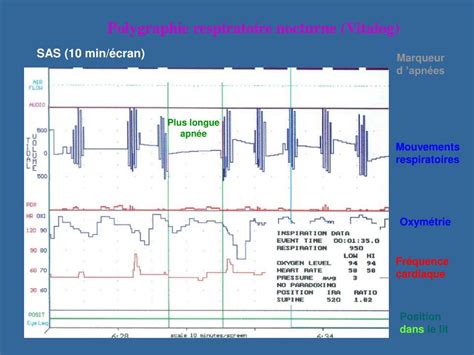 PPT Le Syndrome des Apnées Obstructives du Sommeil OSAS PowerPoint