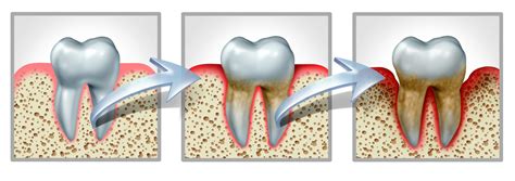 Four Beneficial Periodontal Disease Treatments Austin Laser Dentist