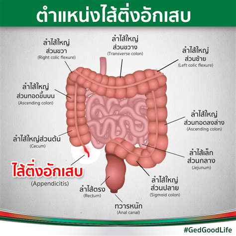 ไส้ติ่งอักเสบ อาการปวดท้องข้างขวาล่าง ที่ต้องรีบผ่าตัดก่อนไส้ติ่งแตก