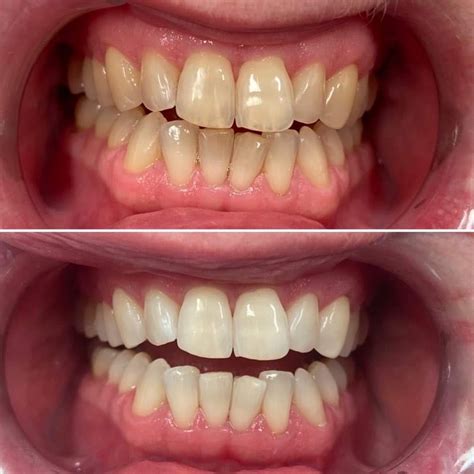 Wybielanie Z B W Metamorfozy Smileup Stomatolodzy Warszawa Dentysta