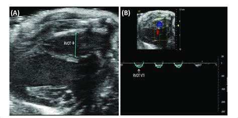 A Right Ventricular Outflow Tract Rvot Measures The Size Of The Download Scientific Diagram