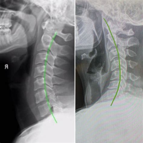 Cervical Spine X Ray Anatomy