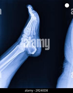 X Ray Normal Foot Lateral Stock Photo Alamy