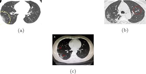 COVID-19 Positive CT scan images | Download Scientific Diagram