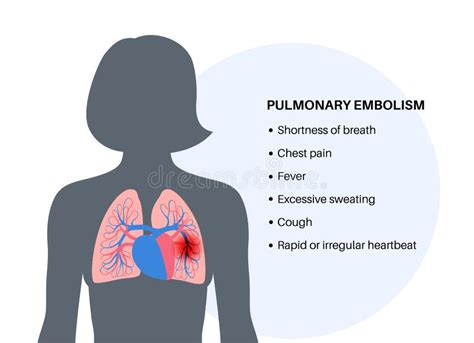 Pulmonary embolism disease stock illustration. Illustration of symptom - 255910920