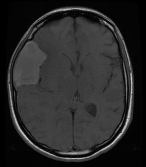 Arachnoid cyst MRI - wikidoc