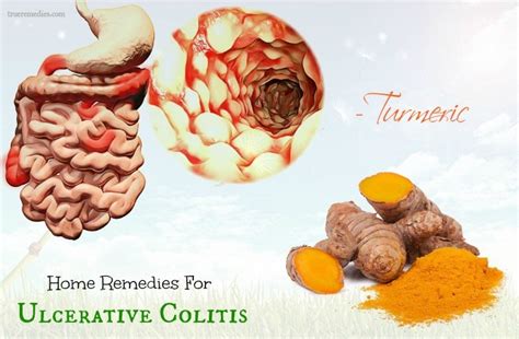 25 Home Remedies For Ulcerative Colitis Symptoms