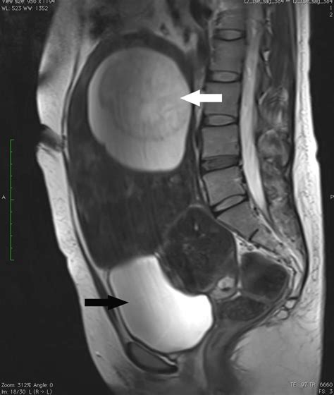 Left 35 Year Old Woman With A Large Leiomyoma Arising From Download Scientific Diagram