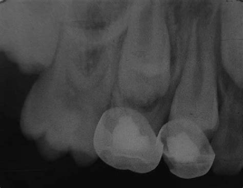 Radiography Of A Successful Case Of Formocresol Fc Maxillary Left