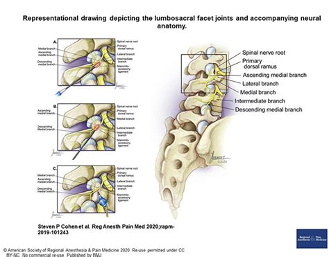 Rhizolysis Brain And Spine Centre Westmead Neurosurgeons Westmead Nsw