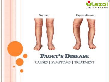 PPT – Paget’s disease : causes, symptoms, diagnosis and treatment ...