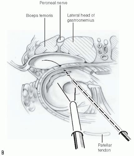 Meniscus Repair Inside Out Suture Technique Musculoskeletal Key