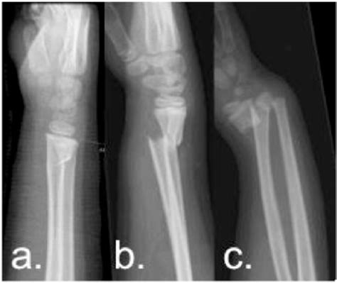 Severity Of The Fracture Defined As A Cortex B Cortices Or C