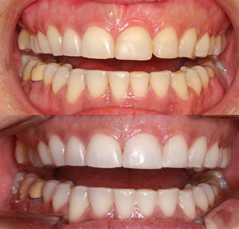 Conoces los diferentes tipos de blanqueamientos dentales Clínica