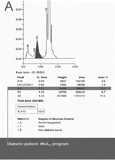 B Hplc Chromatograms With Interpretation The Hba1c Peak Is Shaded